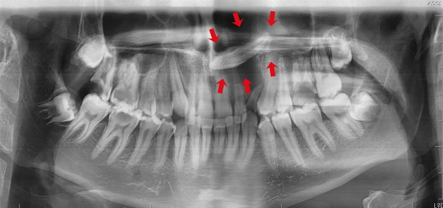 Batman’da Nadir Görülen Ameliyat Burun Tabanındaki Diş Ve Kist Başarıyla Çıkarıldı (3)