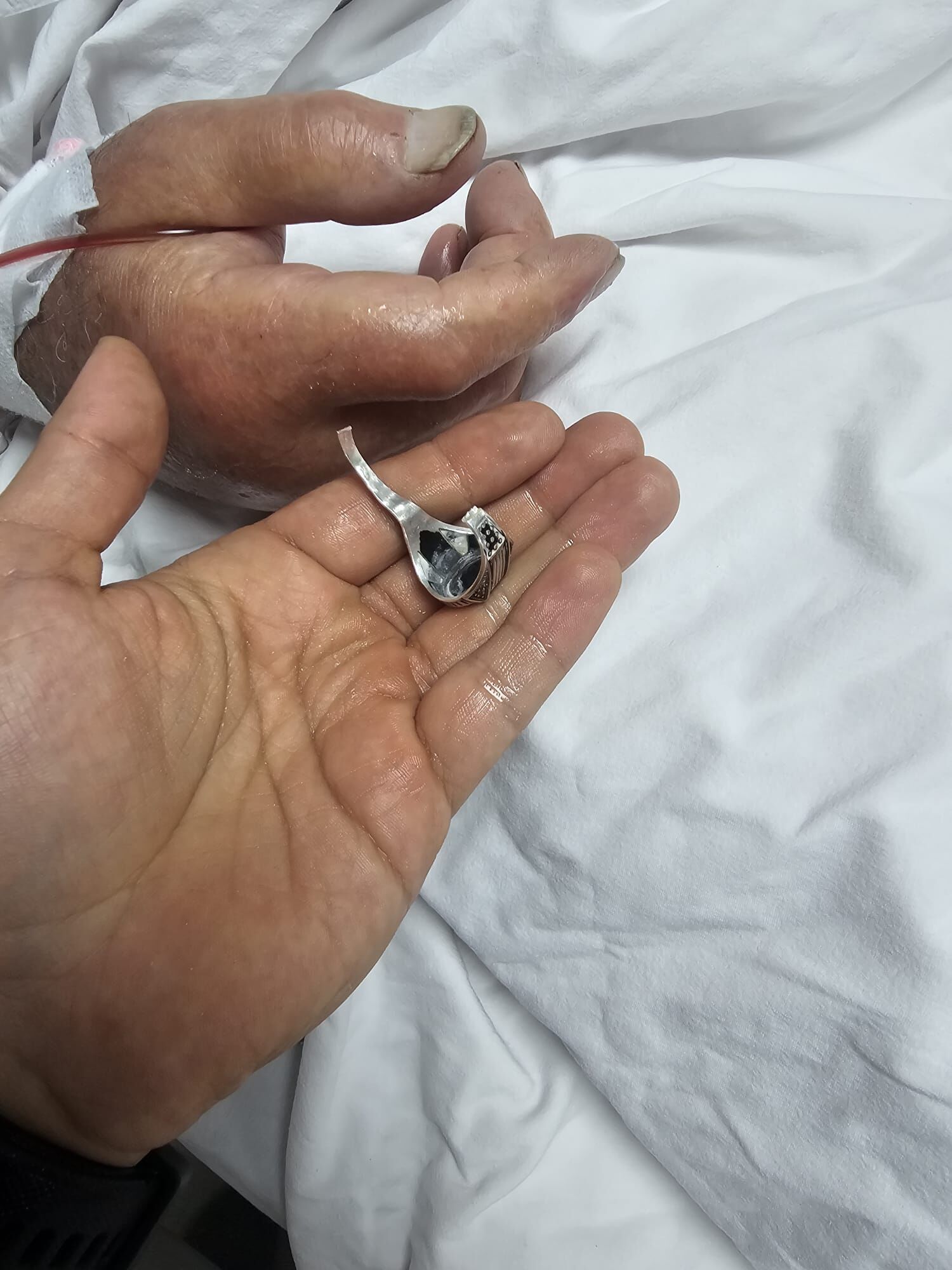 Yoğun Bakımda Tedavi Göre Hastanın Parmağına Yüzük Sıkıştı1