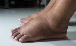 Ayak ve bacak şişmesi için hangi bölüme gidilir