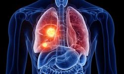 Akciğer kanseri riskini artıran faktörler