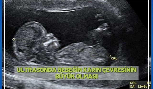 Ultrasonda bebeğin karın çevresinin büyük olması