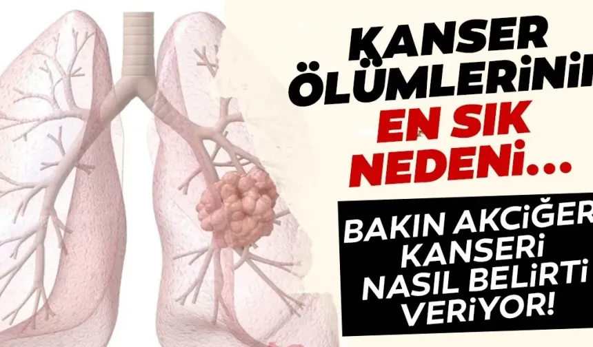 Akciğer kanseri 4. evre ağızdan kan gelmesi