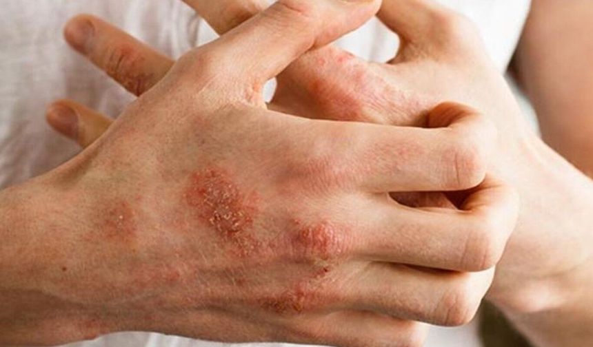 Uzmanlardan egzama uyarısı: Belirtileri ihmal etmeyin